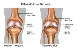 Osteoarthritis Pain Relief In Orlando, FL - Harmony Wellness Center