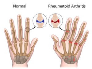 Rheumatoid Arthritis Pain Relief In Orlando, FL - Harmony Wellness Center